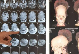 Une tumeur au cerveau d'un poids record opérée en Inde