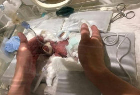  Japon:  un bébé garçon naît à 268 grammes