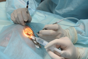 Chirurgie de la cataracte : Des implants de mauvaise qualité marqués CE