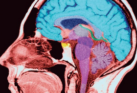 Schizophrénie: les troubles cognitifs seraient liés à l`inflammation cérébrale