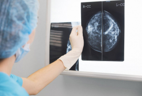 Un cancer du sein avancé guéri par immunothérapie, une première mondiale