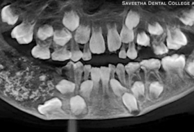 En Inde, 526 dents trouvées dans la bouche d'un garçon de sept ans