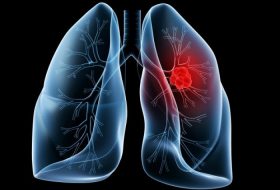 Des médecins avertissent d’une toux pouvant être un symptôme de cancer du poumon