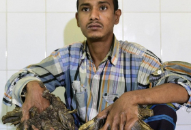 L`«homme arbre» du Bangladesh va bientôt être opéré