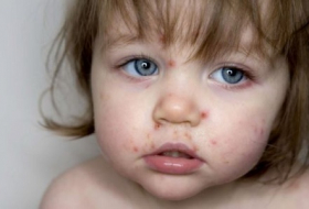 Une maman l’alerte: Ne donnez pas d`ibuprofèn à enfant en cas de varicelle